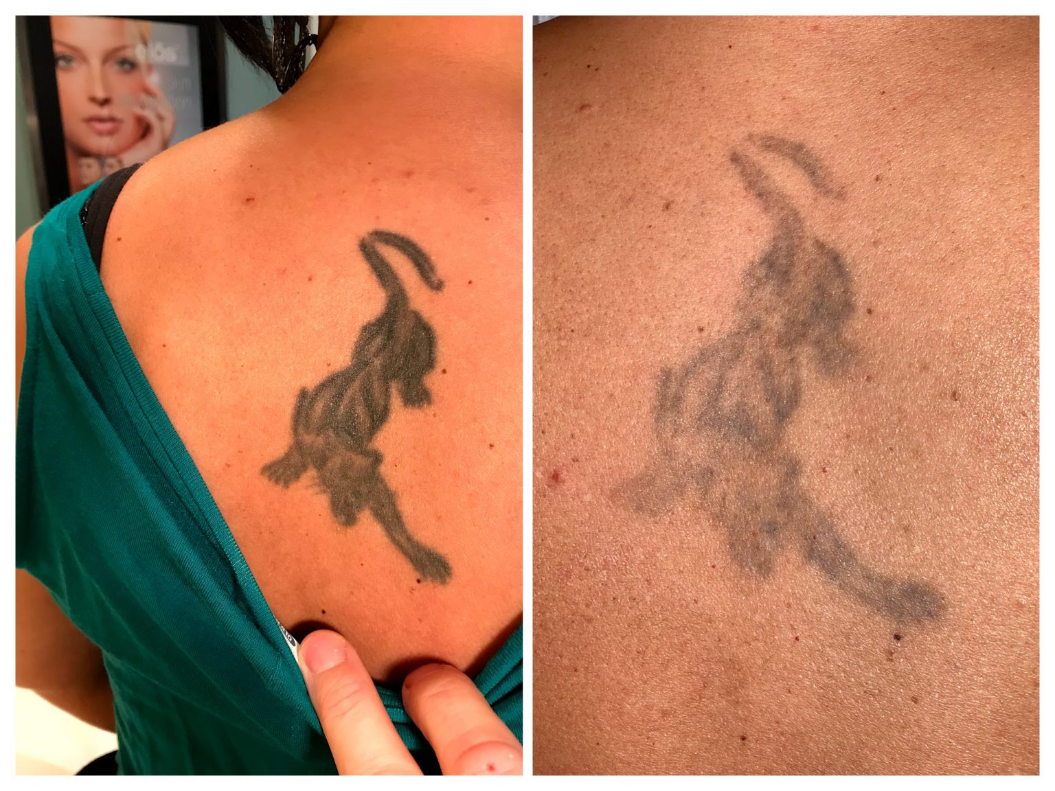 Laser Tattoo Removal in Lehigh Valley Best Tattoo Removal