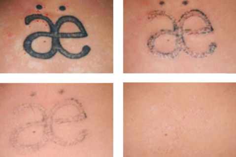 Laser Tattoo Removal fading