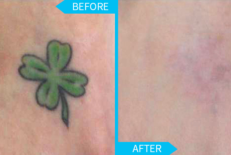 Tats Off: Targeting the Immune System May Lead to Better Tattoo Removal |  Scientific American