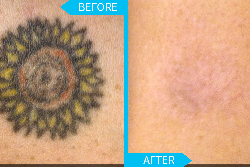 Laser Tattoo Removal at Valley Tattoo Removal